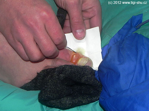 Všechny stupně omrzlin na začátku vypadají stejně, hlavně puchýře nepropichovat! …ale dostaňte se do boty