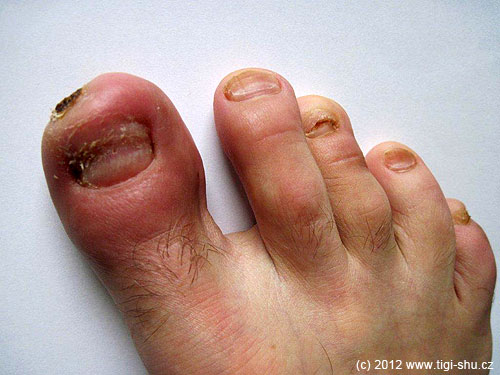 15. 6. 2012 Rekonvalescence v začátcích