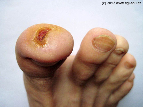 13. 7. 2012 Prst je čím dál tím lepší